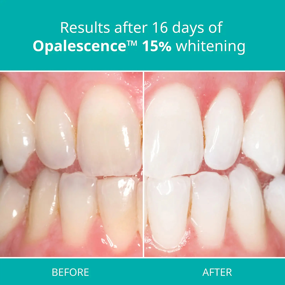 Kit de blanchiment professionn - Teeth Whitening Gel Opalescence avis et prix