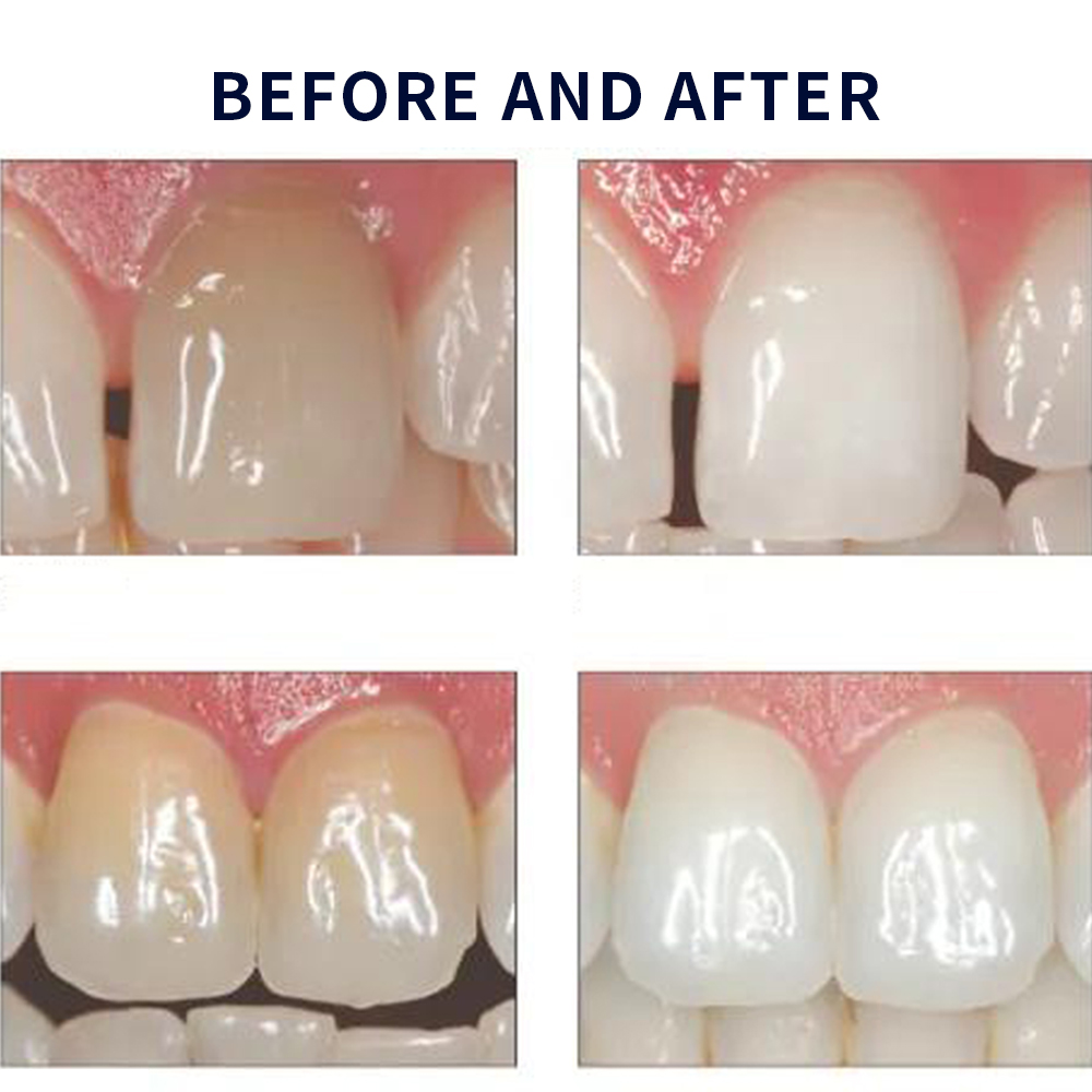Opalwisdom-Kit de Blanchiment  - Teeth Whitening Gel Opalescence avis et prix