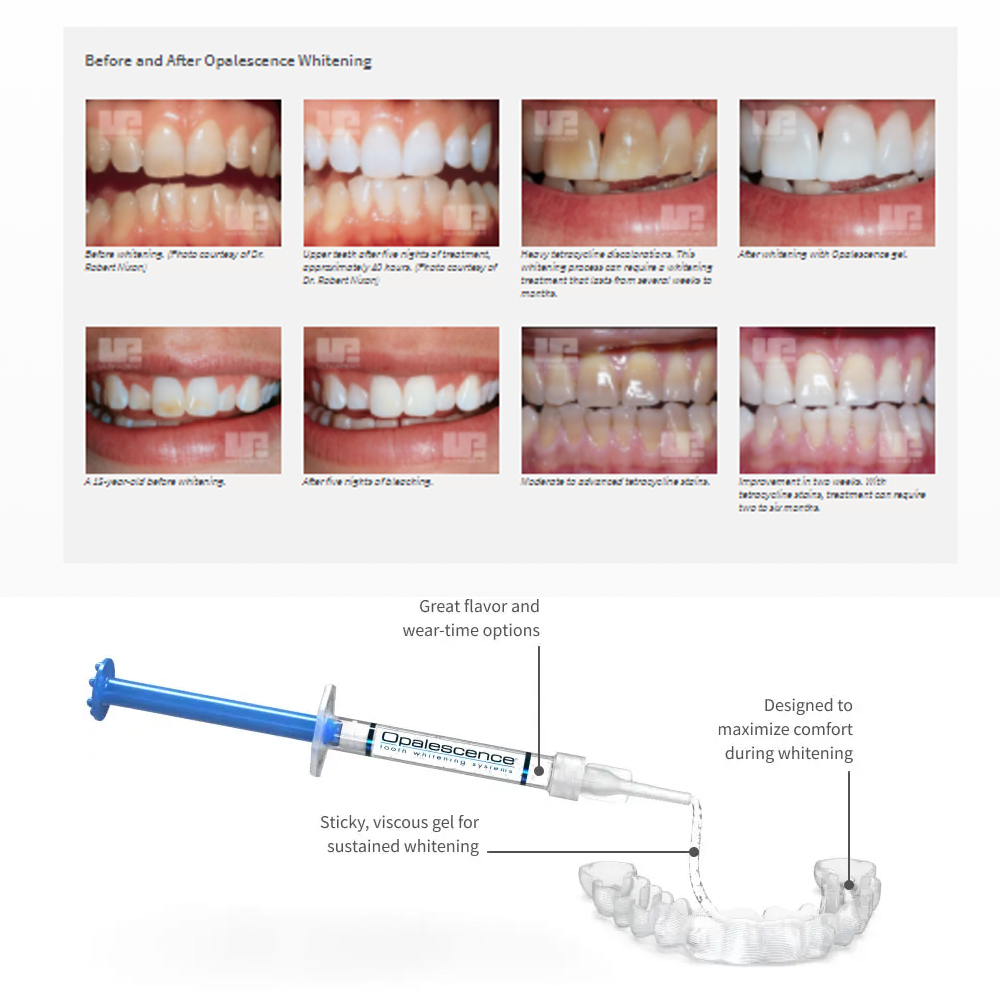 Opalwisdom-Kit de Blanchiment  - Teeth Whitening Gel Opalescence avis et prix