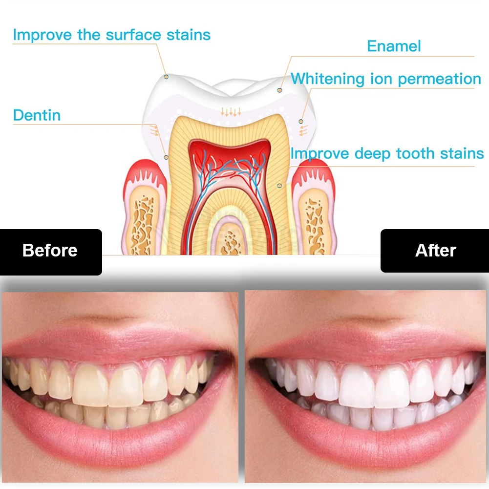 Kit de blanchiment des dents d - Teeth Whitening Blue Light avis et prix