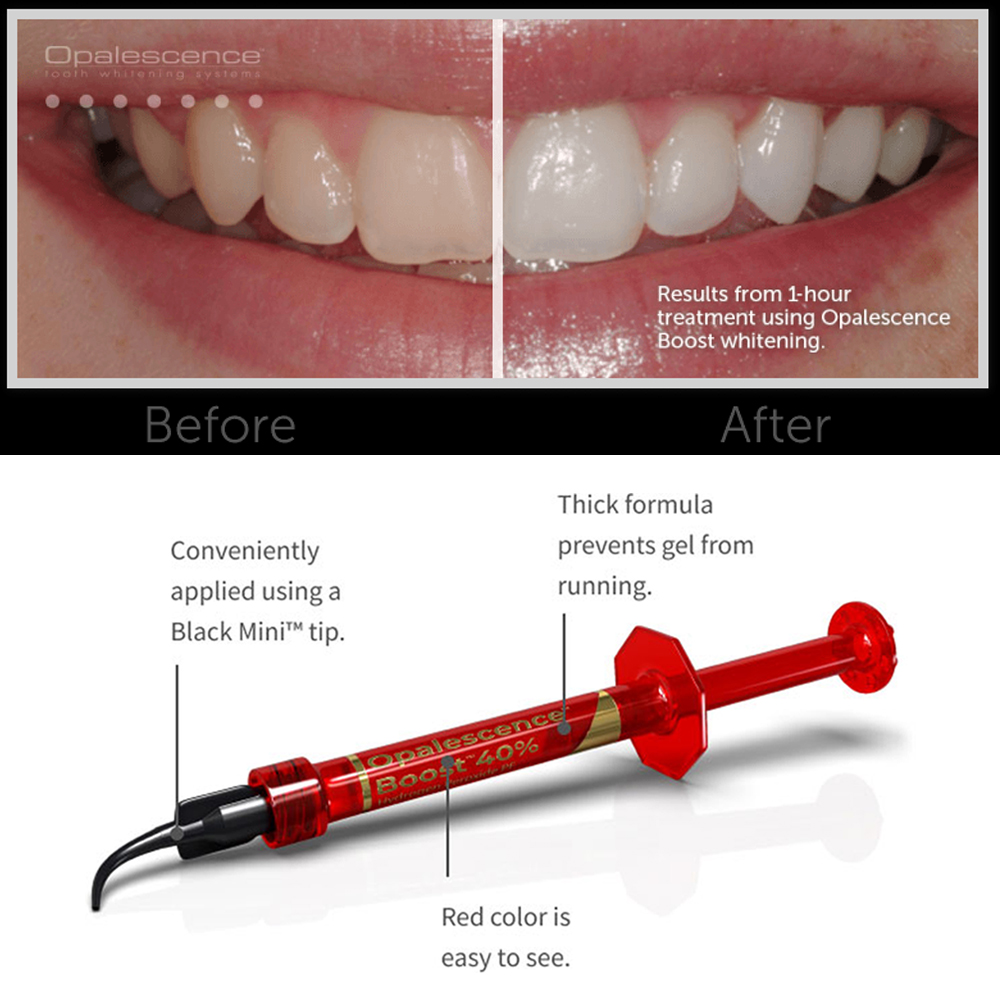 Gel blanchissant pour les dent - Teeth Whitening Gel Opalescence avis et prix
